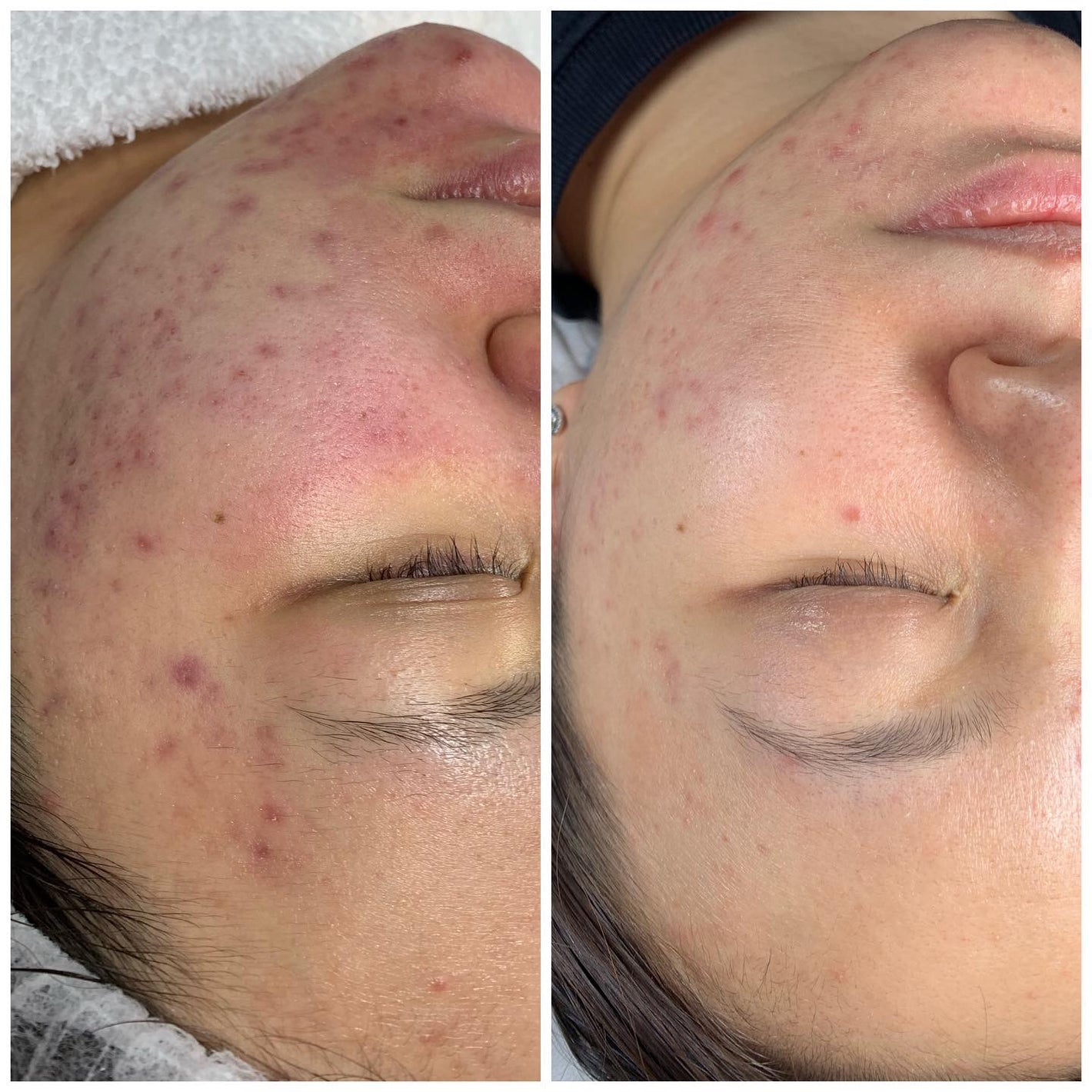 Before and After Acne Treatment in Montreal - Dermature Esthetic Clinic | Traitement de l'acné à Montréal - Clinique esthétique Dermature