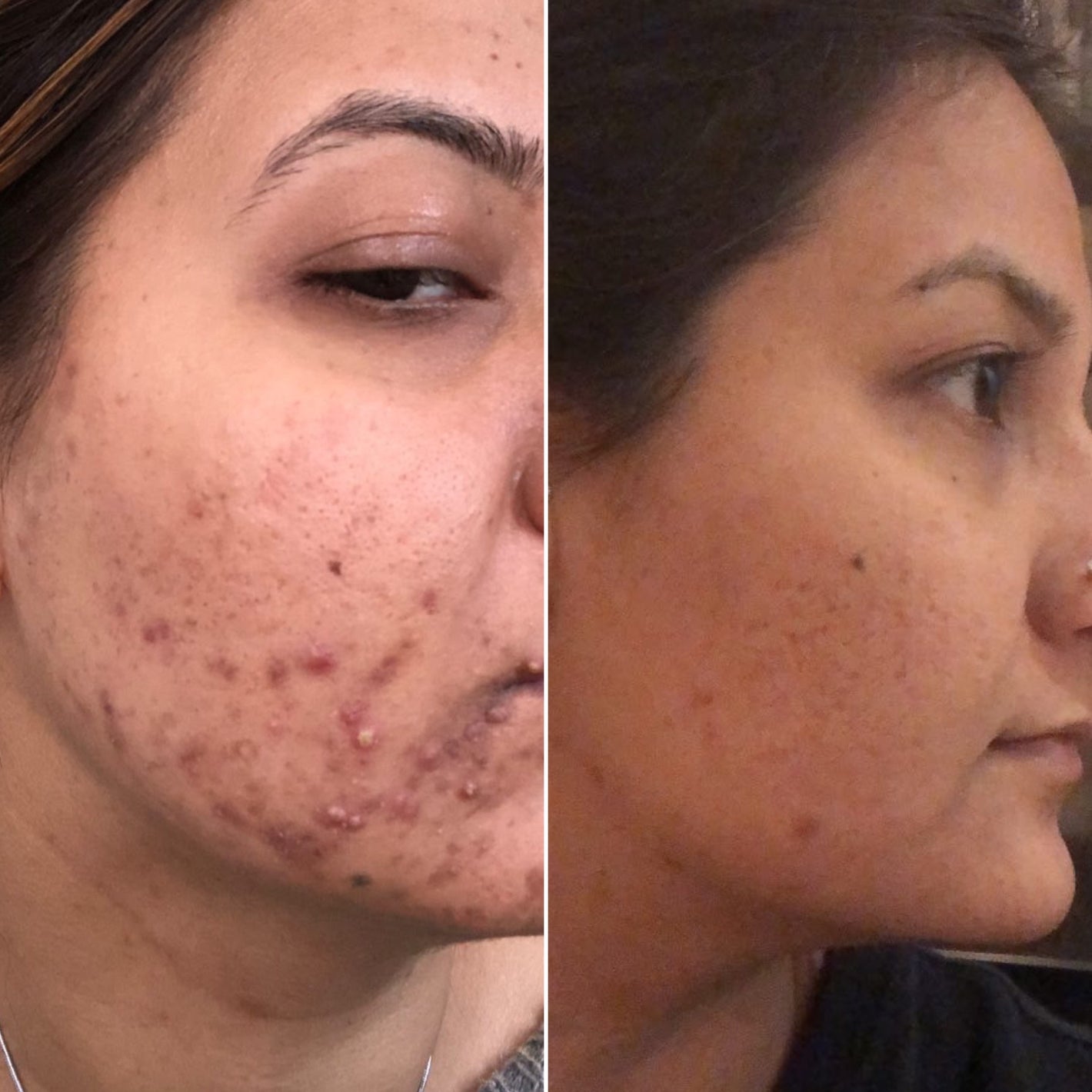 Before & After Acne Treatment in Montreal - Dermature Esthetic Clinic Traitement de l'acné à Montréal - Clinique esthétique Dermature