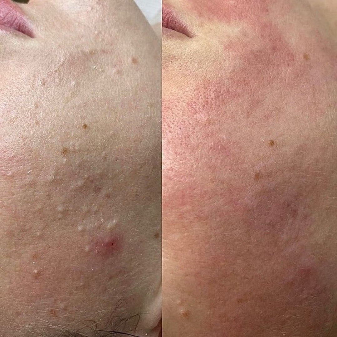 Before & After deep cleansing facial in Montreal - Dermature | Avant et après un nettoyage facial en profondeur à Montréal - Dermature