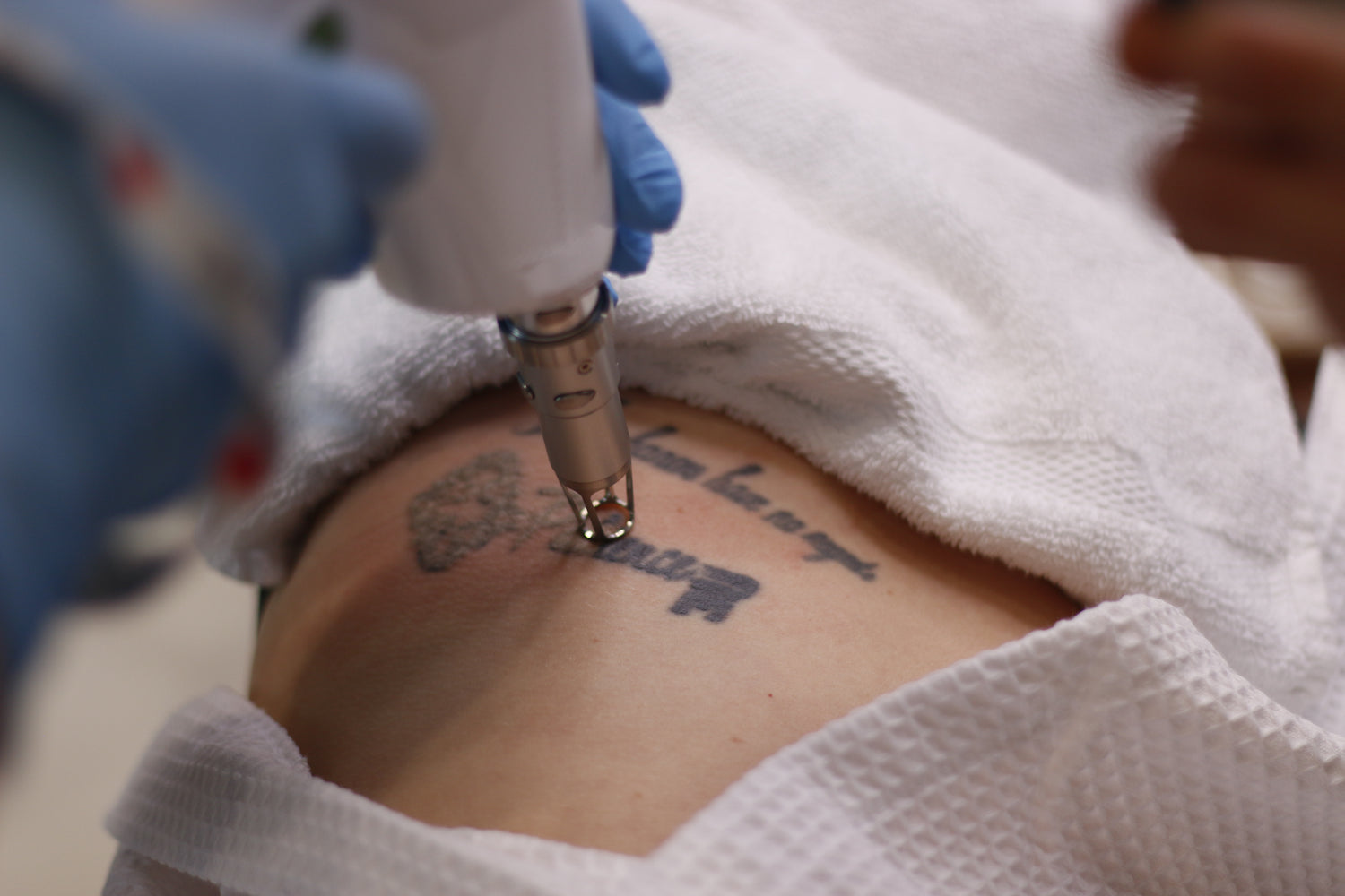 Tattoo Removal in Montreal Westmount - Dermature | Retrait de Tatouage à Montréal Westmount - Dermature