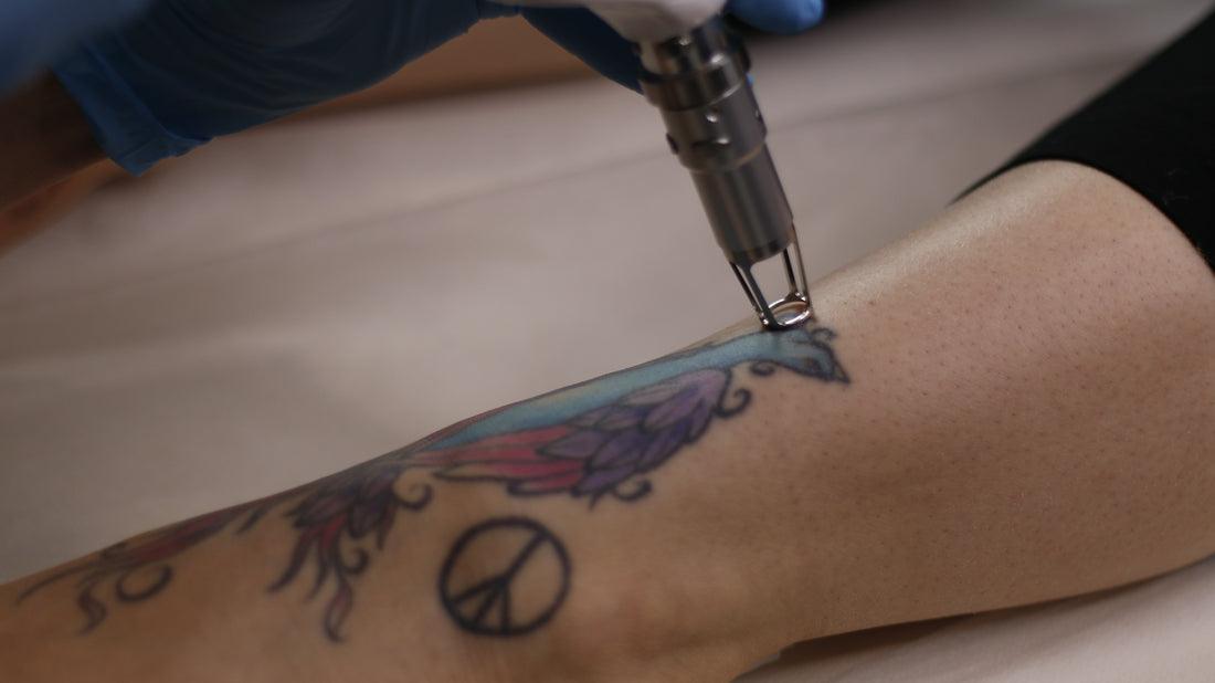 Tattoo removal in Montreal near me - Dermature | Enlèvement de tatouage à Montréal près de moi - Dermature