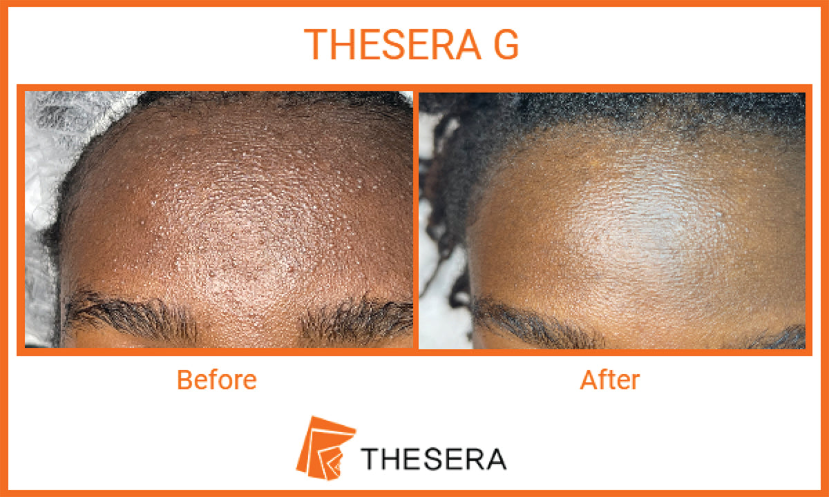 THESERA G Auto Regeneration Spicule Therapy in Montreal - Dermature | THESERA G - Thérapie par les spicules d'auto-régénération à Montréal - Dermature