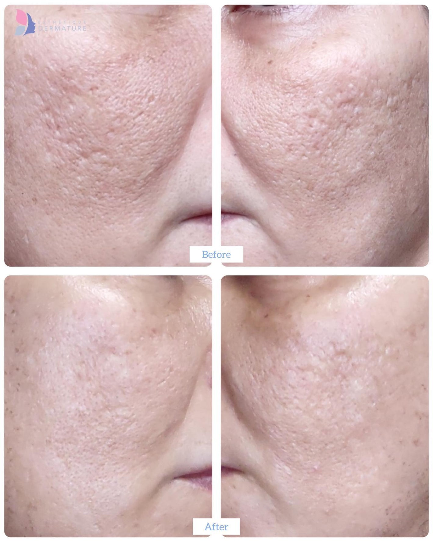 before and after fractional resurfacing