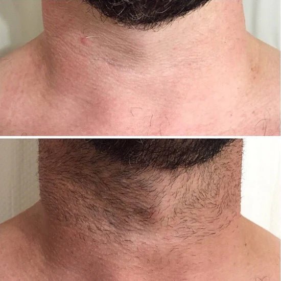 Laser Hair Removal For Men - Dermature
