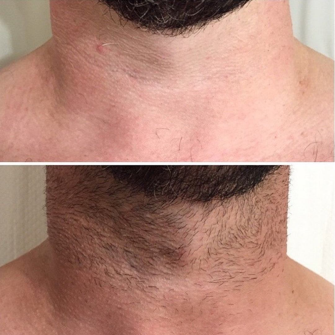 Laser Hair Removal for Men Near Me Montreal - Dermature | Épilation au laser pour hommes près de moi à Montréal - Dermature