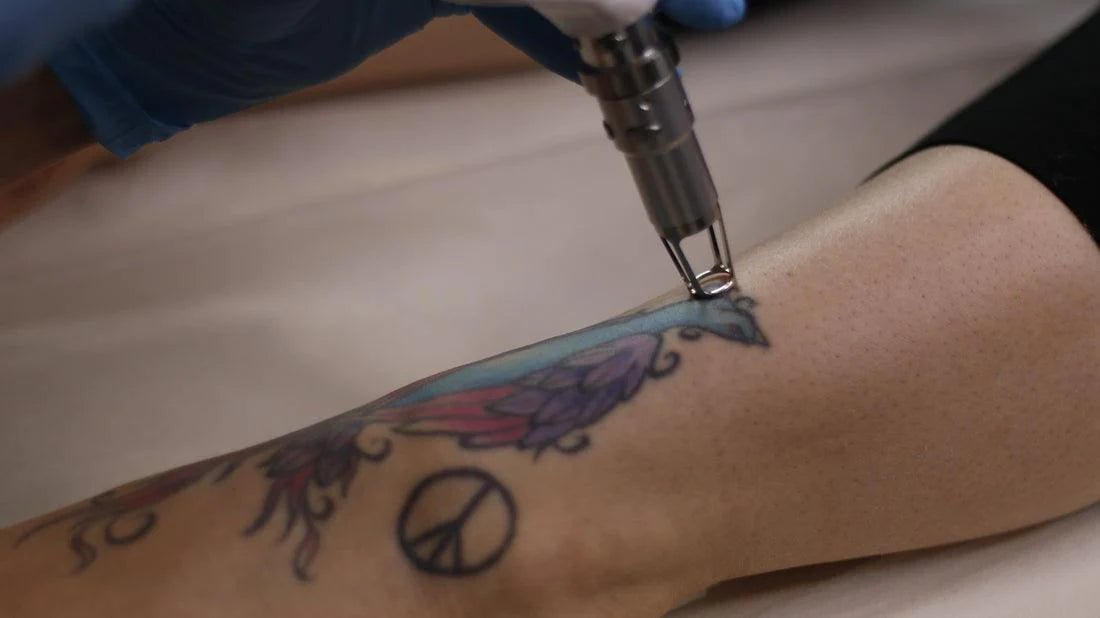 Tattoo Removal - Dermature